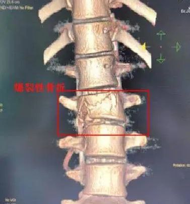 20岁大学生从10米高桥上跳水致腰椎爆裂性骨折